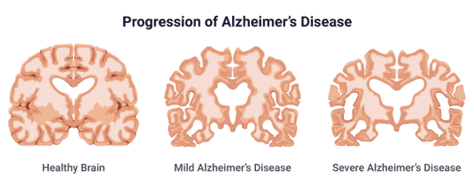 progression-of-Alzheimers-disease